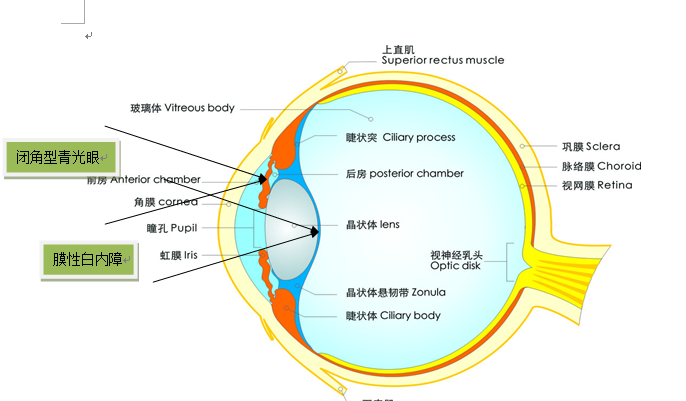 膜性白内障和闭角青光眼激光位置示意图